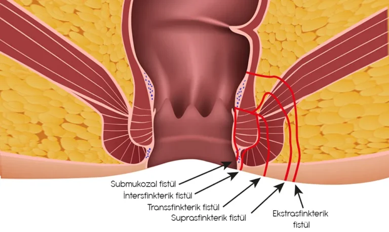 Anal Fistül Nedir ?