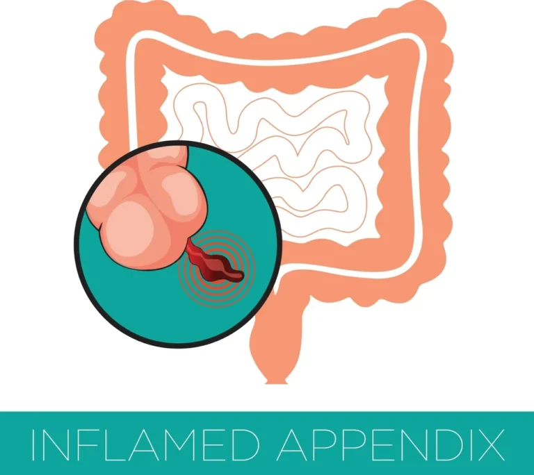 Apandisit Nedir?