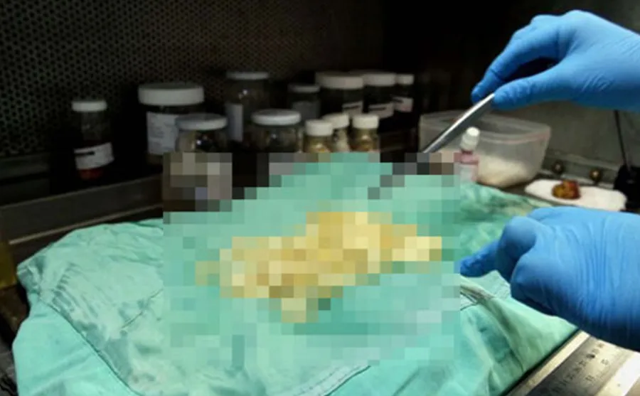 Ameliyatta fark edildi, doktorlar bile şoke oldu