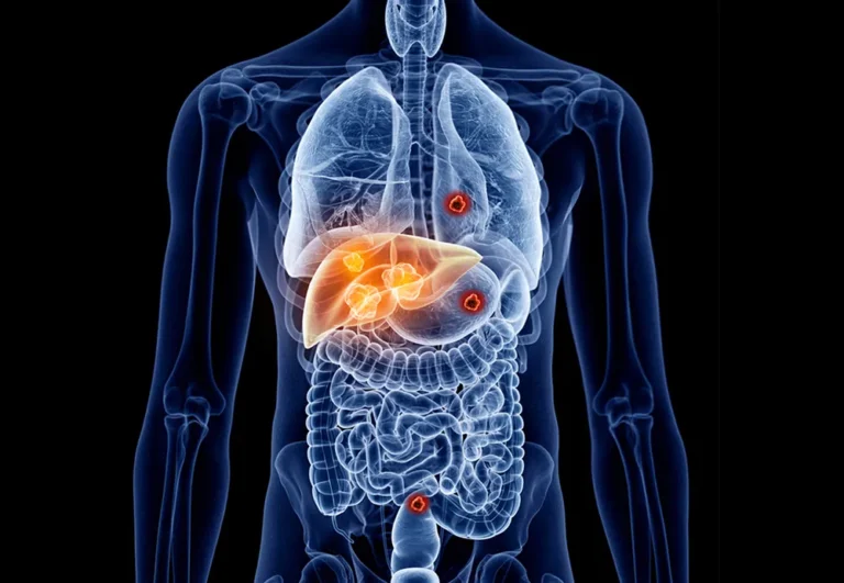 Karaciğer Metastazları