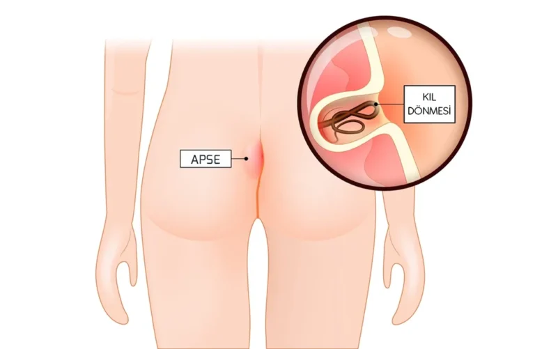Kıl Dönmesi Nedir ?